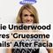 Carrie Underwood Shares ‘Gruesome Details’ After Facial Injury ‘Between 40 and 50 Stitches’