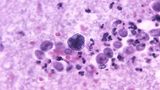 North Carolina teen critically ill from brain-eating amoeba that recently killed Louisiana child