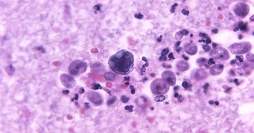 North Carolina teen critically ill from brain-eating amoeba that recently killed Louisiana child