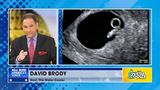 David Brody debunks the Left’s ‘antiquated and disproven’ theory on abortion