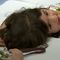 Twins Conjoined at the Head Undergo Successful Surgery in Britain
